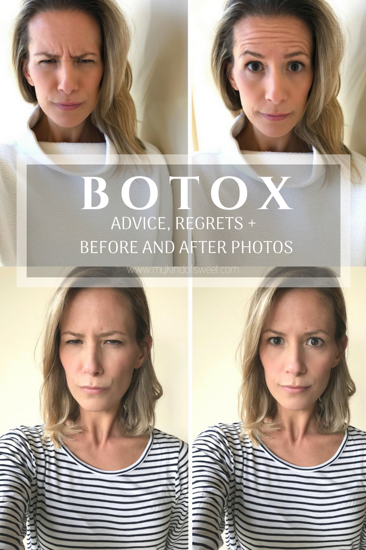 Botox: advice, regrets +before and after