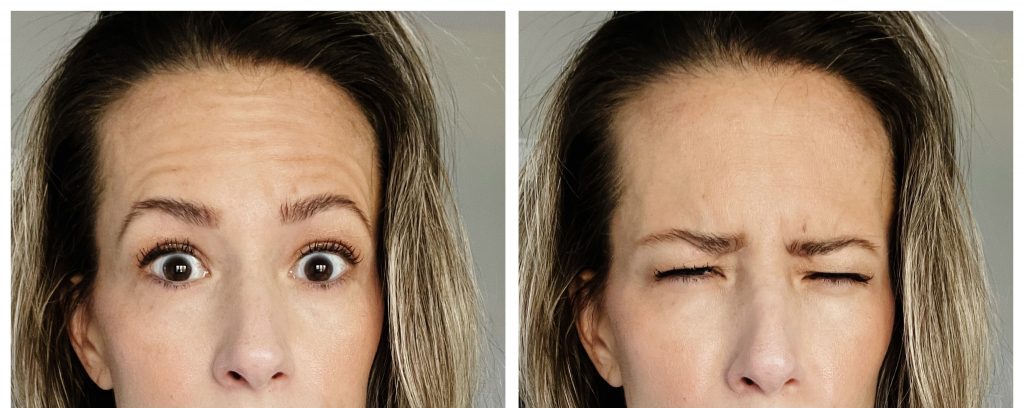 Botox, before